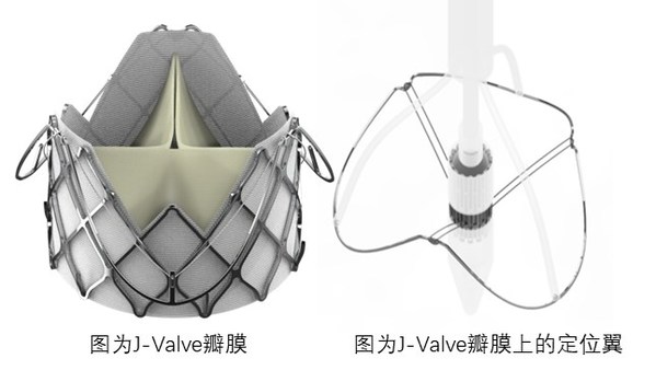 J-Valve瓣膜上的定位翼完全張開，可以找到主動(dòng)脈竇并能自我調(diào)整對(duì)準(zhǔn)瓣膜植入點(diǎn)；杰成將這一過程命名為“自主導(dǎo)航定位系統(tǒng)”