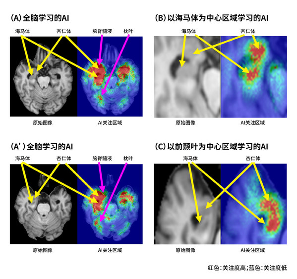 富士膠片AI技術(shù)可預(yù)測(cè)認(rèn)知癥是否會(huì)進(jìn)展為阿爾茨海默病