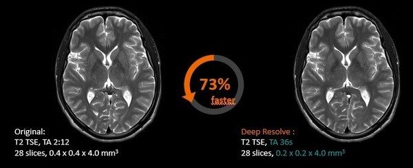 Deep Resolve可將顱腦掃描時間降低70%，并將成像分辨率提高2倍，并可保持相同的圖像質(zhì)量